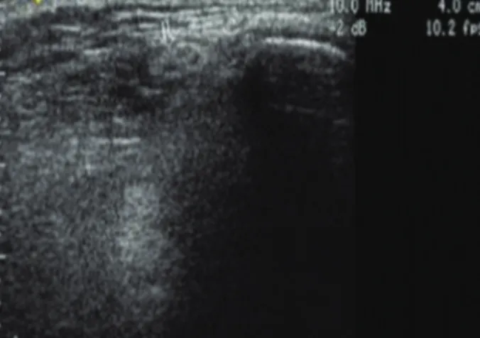 Fig. 1. Measuring  depth of acupoint by ultrasono and gauging the insertion length