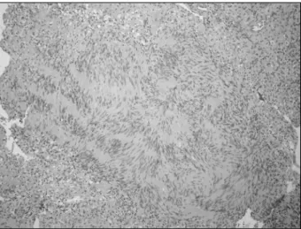 Fig. 5. Histopathologic finding. The tumor is composed of benign spindle cells with nuclear palisading(H-E stain, ×100)