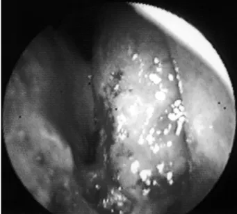 Fig. 1. Endoscopic view shows easily bleeding mass in the nasal cavity. 