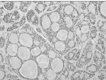 Fig. 6. Light microscopic findings. The adenoid cystic carcinoma component in sublingual gland shows mixed patterns of the tubular type and the cribriform type(H&amp;E, x100)