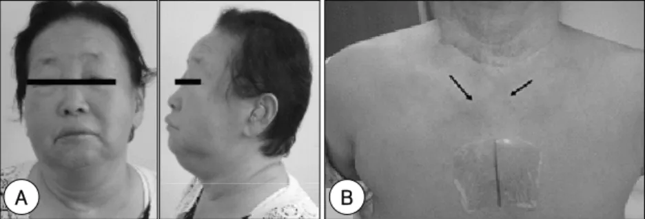 Fig. 1. A：The patient as she appeared with SVCS before self-expanding wallstent insertion (admission day)