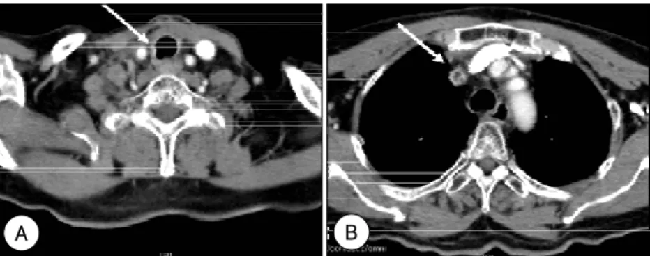 Fig. 4. After external radiation therapy, Neck &amp; chest CT shows that tracheal invasion (A) &amp; tumor thrombus in superior vena cava ( B) are improved