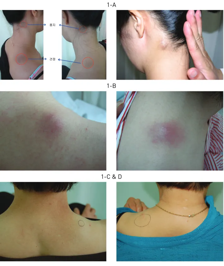 Fig 1. The aspects of inflammatory response caused that prolonged usage of pharmacopuncture lubricant on the specific point (GB20, GB21)