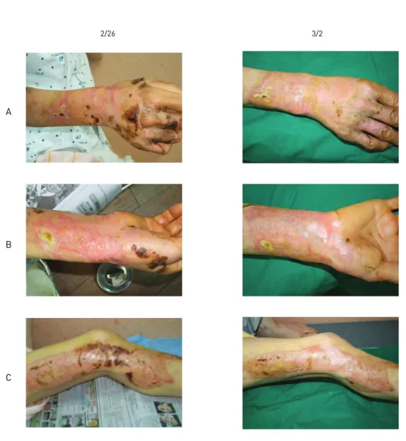 Figure 2. Change of burn image (2/26, 3/2)(`A: The lateral aspect of the upper limb, B: The medial aspect of the upper limb, C: The lateral aspect of the lower limb)A
