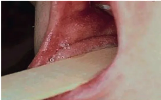 Figure 4. Koplik spots.