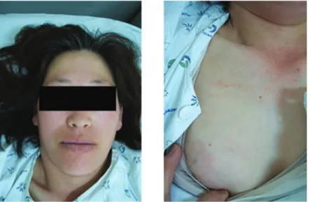Fig. 2 Another patient's aspect suffer from anaphylactic shock after treated with Sweet BV     