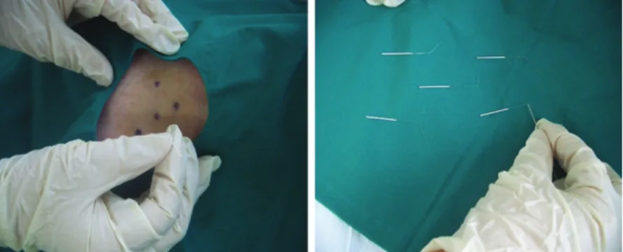 Fig. 1-③. A, B. measuring  depth of acupoint by probe needle and gauging the insertion length