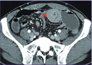 Figure 2. During operation, the intussusception point looked like a mass. 