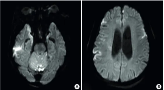 Figure 5. Brain diffusion weighted magnetic resonance imaging shows multifocal cortical infarctions bilaterally  involving the frontoparietal, and temporal lobes and cerebellum (A, B).