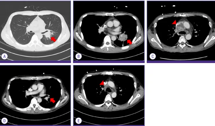 Figure 1. Radiologic findings of this case. (A) Low dose chest computed tomography (CT), performed on day 24 after induction chemotherapy, shows  ill-defined, round consolidation (3.7 cm diameter, arrow) in left hilar area, with adjacent linear opacities a