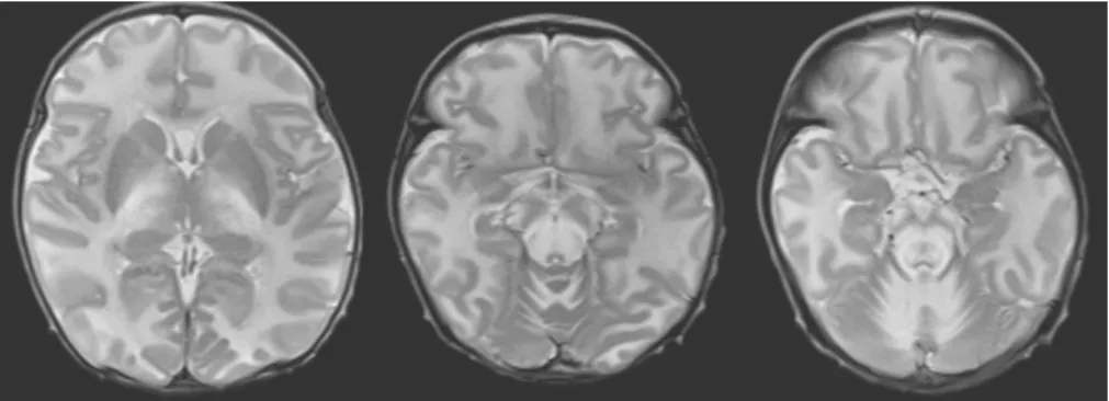 Fig. 1. The brain MRI showed bilateral symmetrical hyperintensity with diffusion restriction, suggesting cytotoxic edema involving the optic chiasm, optic radiate, corticospinal tract, the anterior and posterior limb of internal capsule, thalami, posterior