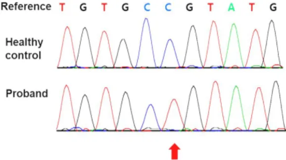 Fig. 2. (A) Electroencephalogram displaying modified hypsarrhythmia, generalized sharp wave and polyspike