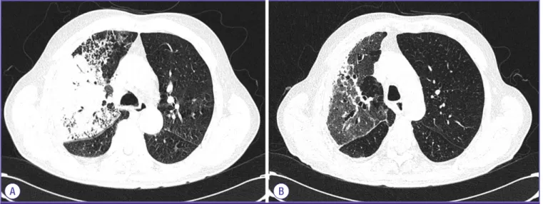 Figure 2. Chest computed tomography (CT). (A) On admission, CT showed lobar pneumonia in the right upper and middle lobes with a parapneumonic  effusion