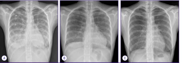 Figure 2. Computed tomography (CT) of chest at admission, showed  diffuse bilateral ground glass opacity in both lungs and a nodular  consoli-dation with pulmonary emphysema in right upper lung.