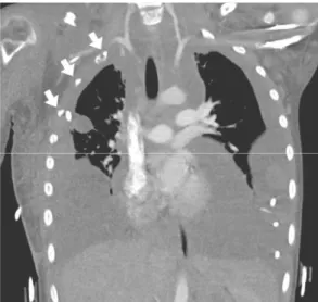 Fig. 1. The initial coronal computed tomography (CT) image in bone windows. Bilateral pleural  effu-sions are noted with osteolytic leeffu-sions (white solid arrows) in the right 1st-3rd ribs.