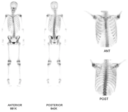 Fig. 2. The initial bone scan (Tc-99m) image. Multiple decreased uptakes are noted in right humeral head, which is consistent with Gorham-Stout  dis-ease
