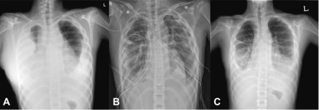 Fig. 3. (A) The initial chest radiograph with a large amount of both pleural effusions