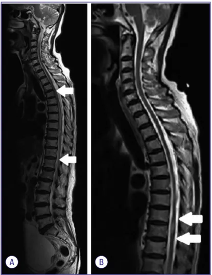 Figure 2. Whole spine MRI (T2-weighted sagittal image) on admission  (A) shows high-signal intensity from level T4 (upper arrow) to T11 (lower  arrow)