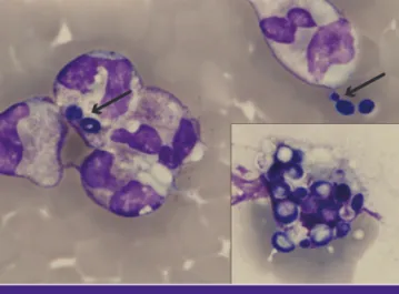 Figure 1. Budding yeast cells in peripheral blood. Peripheral blood smear  shows budding yeast cells (arrows) found both extracellularly and  intracel-lularly (Wright stain ×1,000)