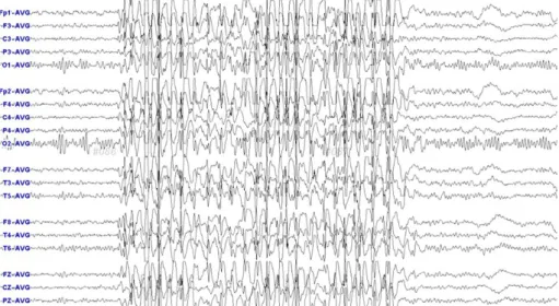 Fig. 1. Ictal  EEG  of  patient  #  10.  3  Hz  generalized  spike  wave  is  seen  on  EEG.를 보였으나 L-dopa와 5HTP 투여 후 경련이 바로 소실되어 DHPR 결핍증이 강력히 의심되어 일본에 재의뢰한  DHPR  활성도  검사에서는  0  nmol/min/5  mm disc로  감소되어  있었다