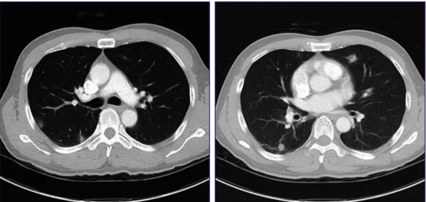 Figure 3. Abdomen computed tomography on portal phase shows small ill-defined hypodense lesions (arrows) in both lobes of the liver.