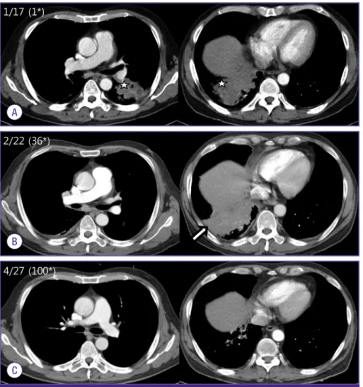Figure 1. Chest computed tomography scan with enhancement. (A) At first admission, lobulating con- con-tour mass-like consolidations with necrosis are visible in the left lower lobe and right lower lobe basal  territory (☆)