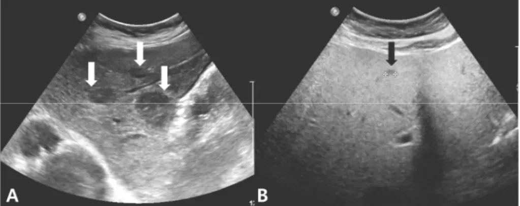 Fig. 1. Abdominal ultrasound (US) finding in Patient 1 showing multiple hepatic adenomas (white arrows) (A) and abdominal US in Patient 2 showing only tiny nodule (black arrow) and  fatty  liver  (B)