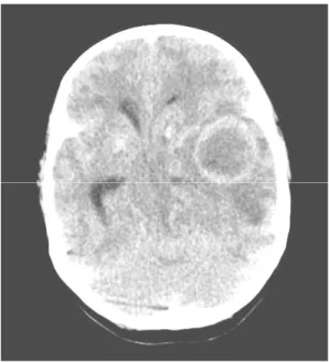 Fig. 1. Computerized tomography of brain showed a 3.5