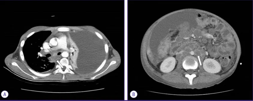 Figure 2. Appearance of pleural fluid and ascites. (A) Pleural fluid drained  by diagnostic thoracentesis, milk-like appearance
