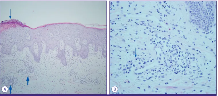 Figure 1. Pathologic findings. (A) The epidermis shows irregular acanthosis, partial parakeratosis,  and focal microabscesses in the keratin layer (thin  arrow)
