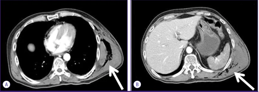 Figure 1. Chest X-ray shows soft tissue swelling on the left chest wall  with internal air density.