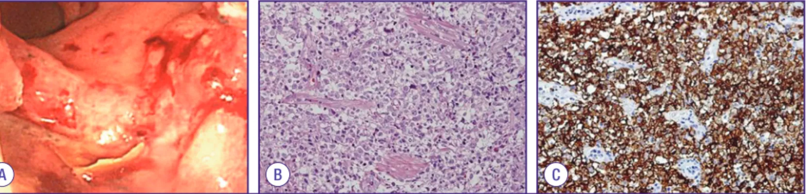 Figure 1. (A) 75% circumferential ulceroinfiltrative lesion in the rectum. (B) H&amp;E stain (×400): Diffuse large B-cell lymphoma