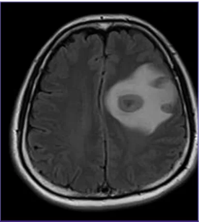 Figure 3. 4-month follow-up chest CT shows a marked decrease in the size  of the nodule in the left lower lobe