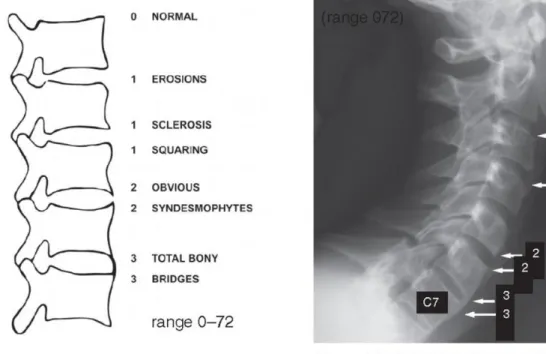 Fig. 6. Modified Stoke Ankylosing Spondylitis Spinal Score(mSASSS)[21]. 