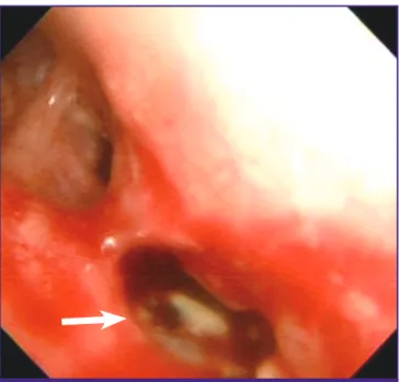 Figure 4. Microscopic finding of chronic granulomatous inflammation with caseous necrosis