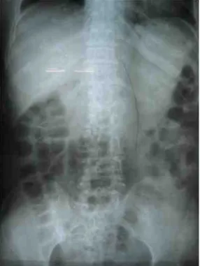 그림  4.  2008.12.17.L-spine  AP  view.