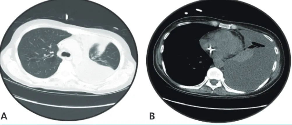 Figure 2. Initial chest non-contrast CT revealed (A) pneumonic consolidation and (B) pleural effusion in the left  lung field