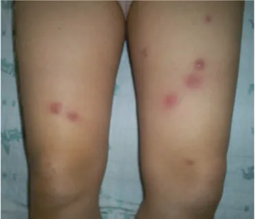 Figure 1. Multiple erythematous nodular lesions secondary to M. abscessus  infection were observed on both lower extremities.