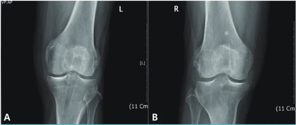 Figure 1. Simple X-ray of both knees. Shows a narrowing interarticular space and spurs forming  on the  margins of the joints.