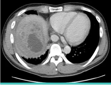 Figure 2. Chest computed tomography shows a huge heterogeneously enhanced  mass with multiple septums measuring 5.9 cm×4.9 cm×3.5 cm at the right   lobe of liver.