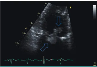 Figure 1. Transthoracic echocardiogram shows two large oscillating vegetations  at the mechanical mitral valve (1.29×1.12 cm, 1.86×1.32 cm).
