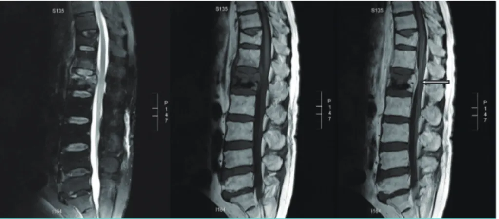 Figure 1. MRI image showing compression deformities on the T11 and L5 vertebral bodies