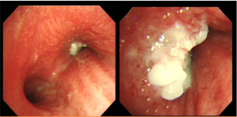 Figure 1. Bronchoscopy shows obstruction of the right main bronchus by endobronchial  polypoid 