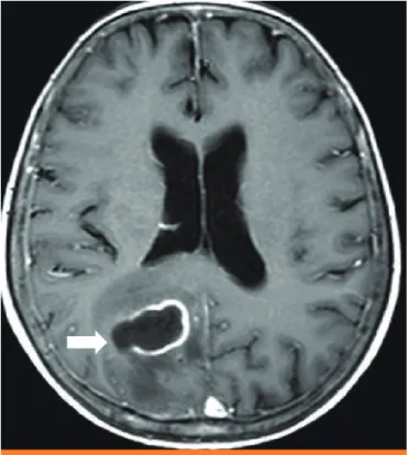 Figure 2. Serial contrast enhanced brain CT images. (A) Initial brain CT scan showed a ring enhancing cystic lesion with surrounding edema in the right parietal lobe