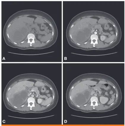 Figure 1. Initial abdominal CT images showing a 12×7.5×13 cm, multi-septated, en- en-hancing, thick walled cystic mass in the right posterior segment of the liver
