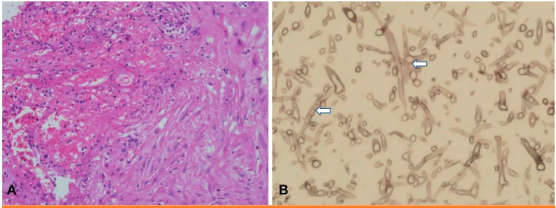 Figure 2. Pathologic findings of the liver abscess in case patient. (A) Abscess formation (left upper) is observed  (hematoxylin &amp; eosin stain, x200)