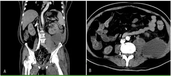 Figure 1. Contrast-enhanced CT scan shows a huge left iliopsoas intramuscular abscess (30 cm) and left perinephric  abscess (10.4 cm) (A, B).