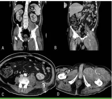 Figure 3. Contrast-enhanced CT scan shows improved left perinephric abscess and  left iliopsoas intramuscular abscess after amphotericin B therapy (A-D).