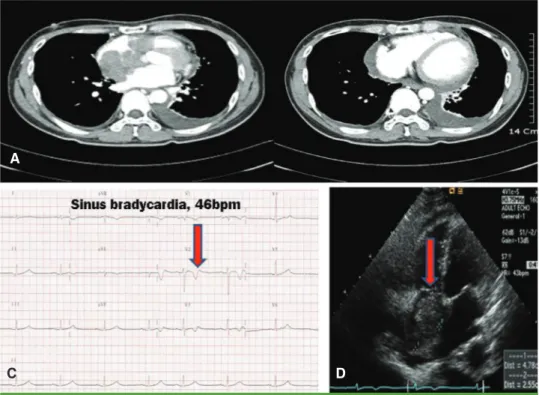 Figure 1.  (A) Chest CT scan taken on hospital day 1. Low attenuated lobulating mass in the right atrium with  pericaridal effusion and left pleural effusion