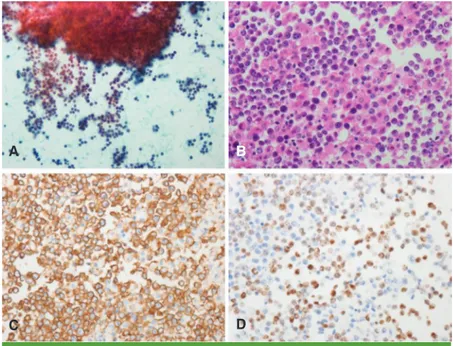 Figure 2. (A) Diffuse sheet of atypical large lymphoid cells are observed in PAP smear mixed with  small reactive lymphocytes